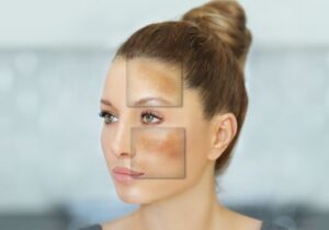 melasma