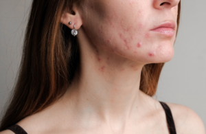 ClearSkin vs. mezoterapia mikroigłowa – co wybrać przy aktywnym trądziku?