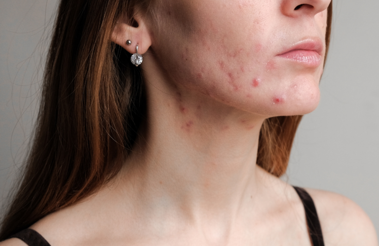 ClearSkin vs. mezoterapia mikroigłowa – co wybrać przy aktywnym trądziku?